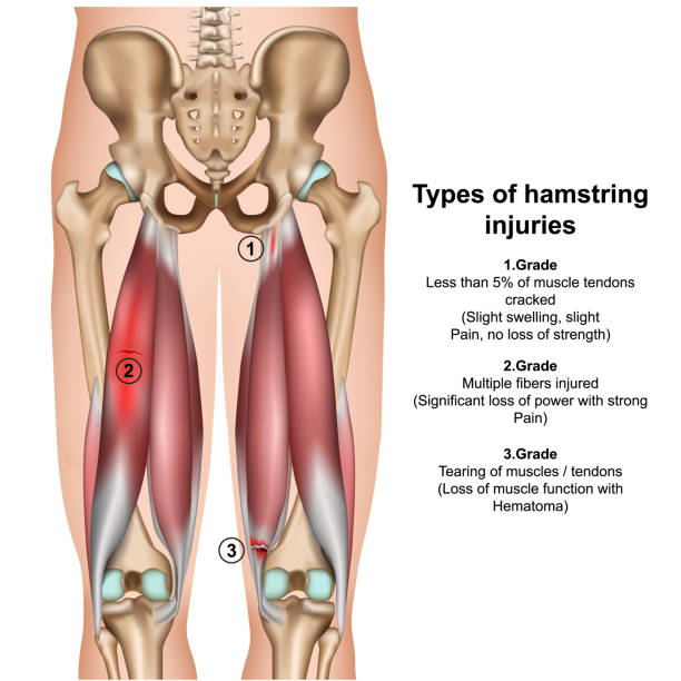 Types of Pulled Hamstring Injuries