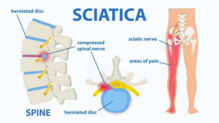 sciatica nerve pain
